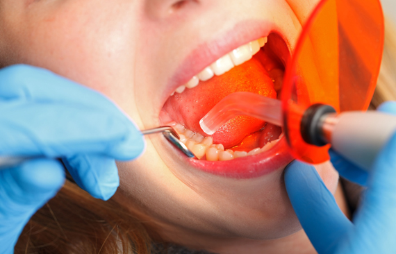 Why Is Dental Bonding Needed