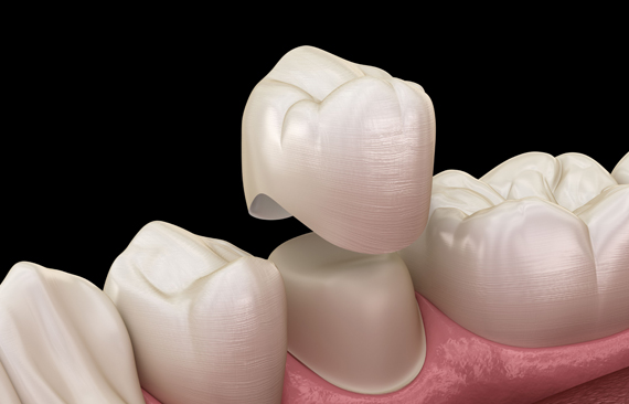 Why Would Dental Crowns Be Needed