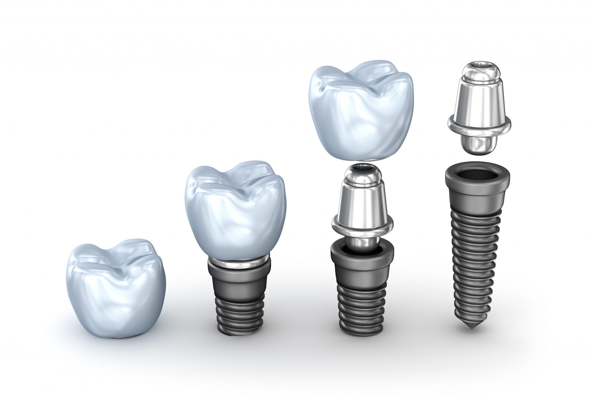 Feature Image 3 Dental Implants