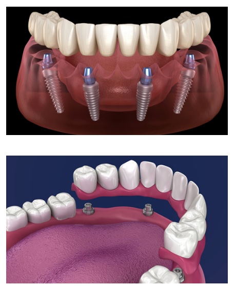 dental implants types - dentist bedford tx